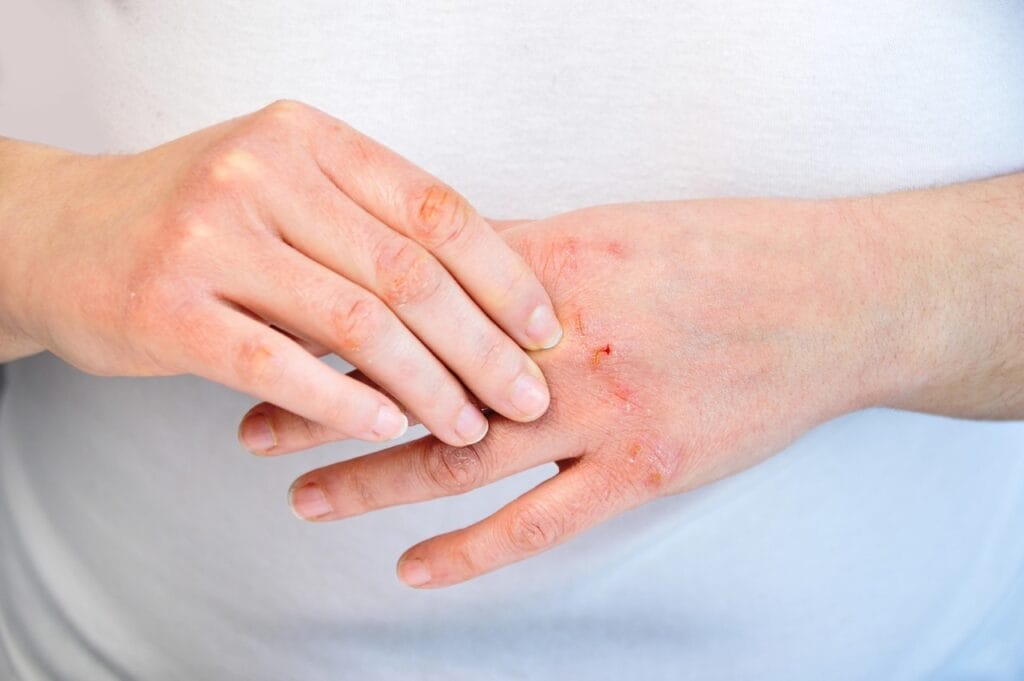 Person experiencing dry, itchy skin from winter indoor allergens